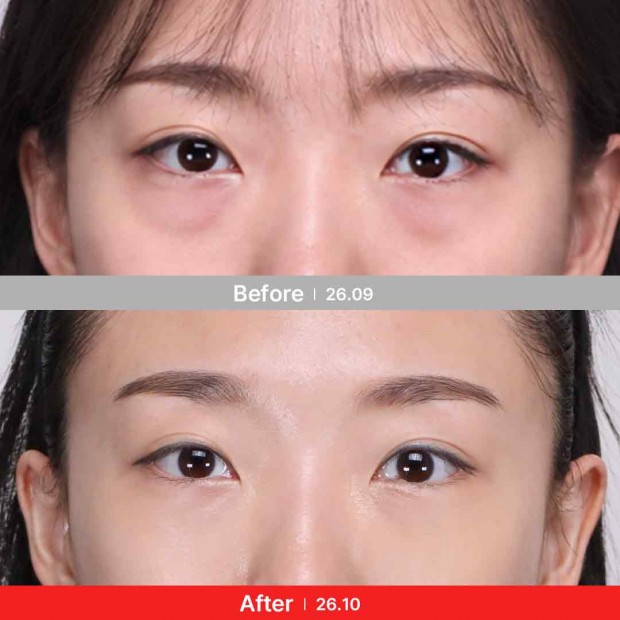 엣지 성형외과&피부과 눈성형 BEFORE / AFTER 전후 비교 정면