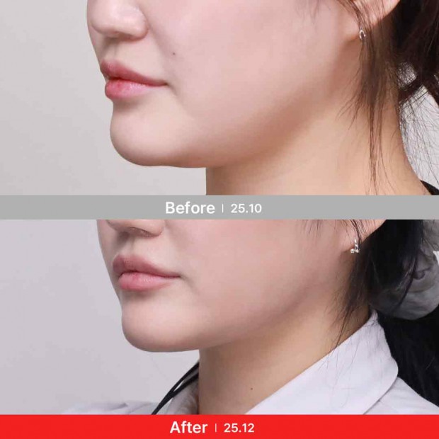 엣지 성형외과&피부과 리프팅 BEFORE / AFTER 전후 비교 정면