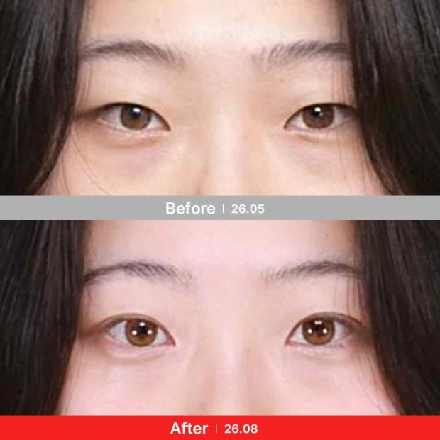 엣지 성형외과&피부과 눈성형 BEFORE/ AFTER 전후 비교 정면
