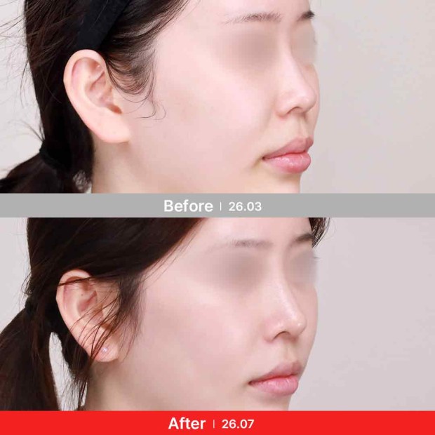 엣지 성형외과&피부과 코성형 BEFORE/ AFTER 전후 비교 45°