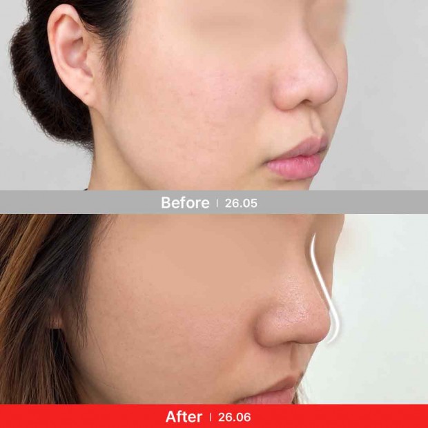엣지 성형외과&피부과 코성형 BEFORE/ AFTER 전후 비교 45°