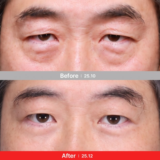 엣지 성형외과&피부과 눈성형 BEFORE / AFTER 전후 비교 정면