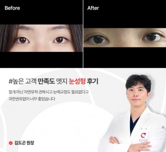 엣지성형외과&피부과 눈성형 후기