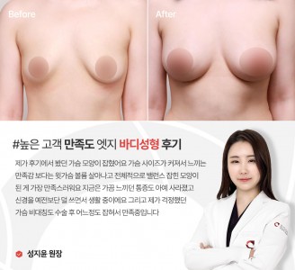 엣지성형외과&피부과 바디성형 후기