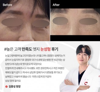 엣지성형외과&피부과 눈성형 후기