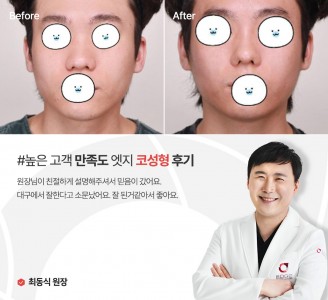 엣지성형외과&피부과 코성형 후기