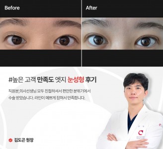 엣지성형외과&피부과 눈성형 후기