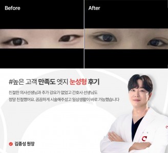 엣지성형외과&피부과 눈성형 후기