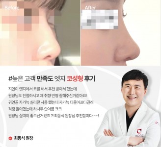 엣지성형외과&피부과 코성형 후기