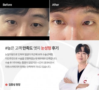 엣지성형외과&피부과 눈성형 후기