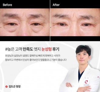엣지성형외과&피부과 눈성형 후기