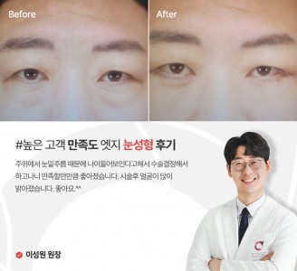 엣지성형외과&피부과 눈성형 후기
