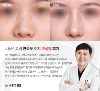 엣지성형외과&피부과 코성형 후기