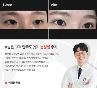엣지성형외과&피부과 눈성형 후기