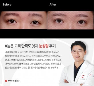 엣지성형외과&피부과 눈성형 후기