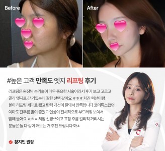엣지성형외과&피부과 리프팅 후기