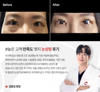 엣지성형외과&피부과 눈성형 후기