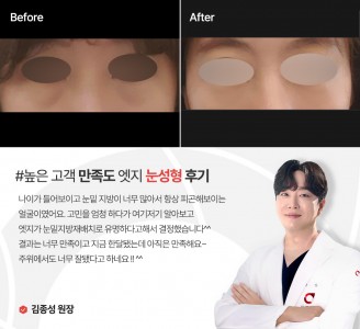 엣지성형외과&피부과 눈성형 후기
