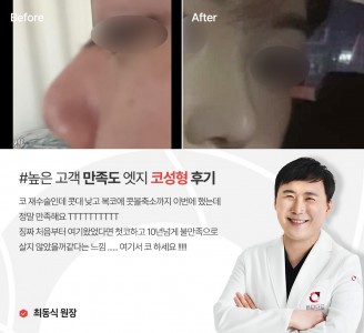 엣지성형외과&피부과 코성형 후기