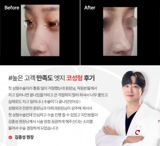 엣지성형외과&피부과 코성형 후기