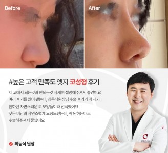 엣지성형외과&피부과 코성형 후기