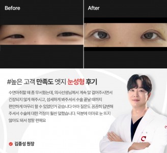 엣지성형외과&피부과 눈성형 후기