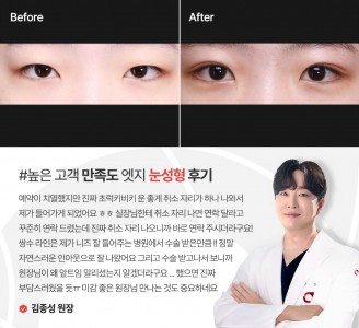 엣지성형외과&피부과 눈성형 후기