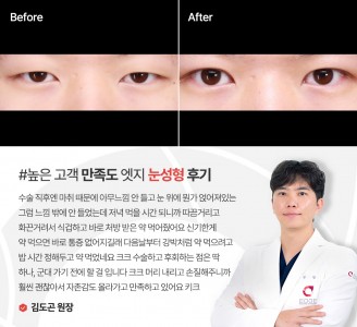엣지성형외과&피부과 눈성형 후기