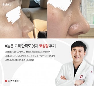 엣지성형외과&피부과 코성형 후기