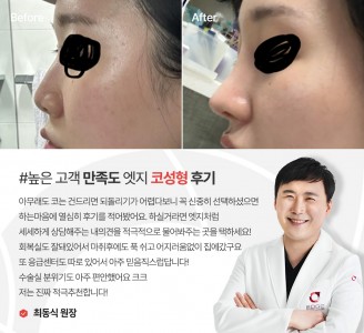 엣지성형외과&피부과 코성형 후기