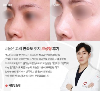 엣지성형외과&피부과 코성형 후기