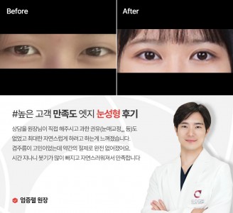 엣지성형외과&피부과 눈성형 후기