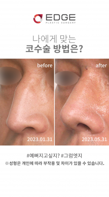 남자 매부리코수술 전후 레전드