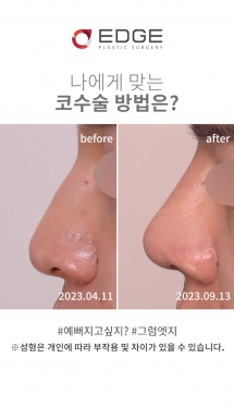 더 잘생겨지는 남자코성형