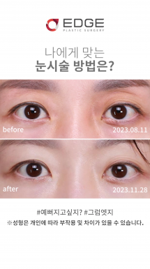 눈꺼풀처짐 해결방법!