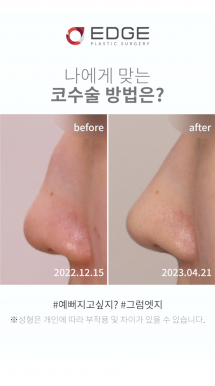 매부리코수술 후기 레전드
