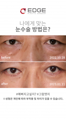 동안성형