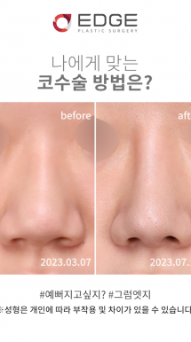 뭉툭한 코끝 줄이는 방법