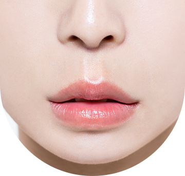 lip_lift06
