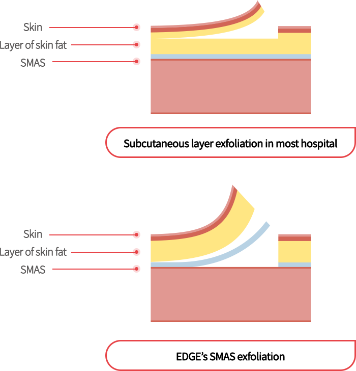 mini_incisio_img04_m