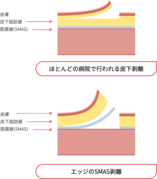 mini_incisio_img04_m