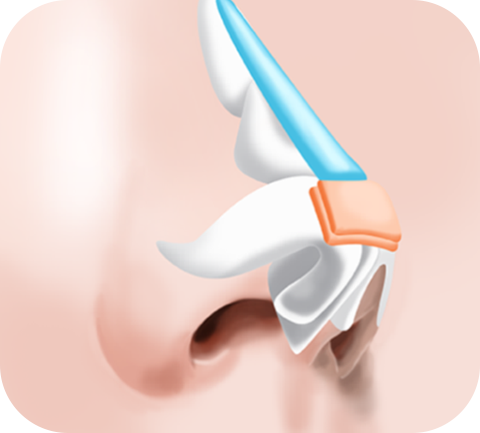 rhinoplasty_img