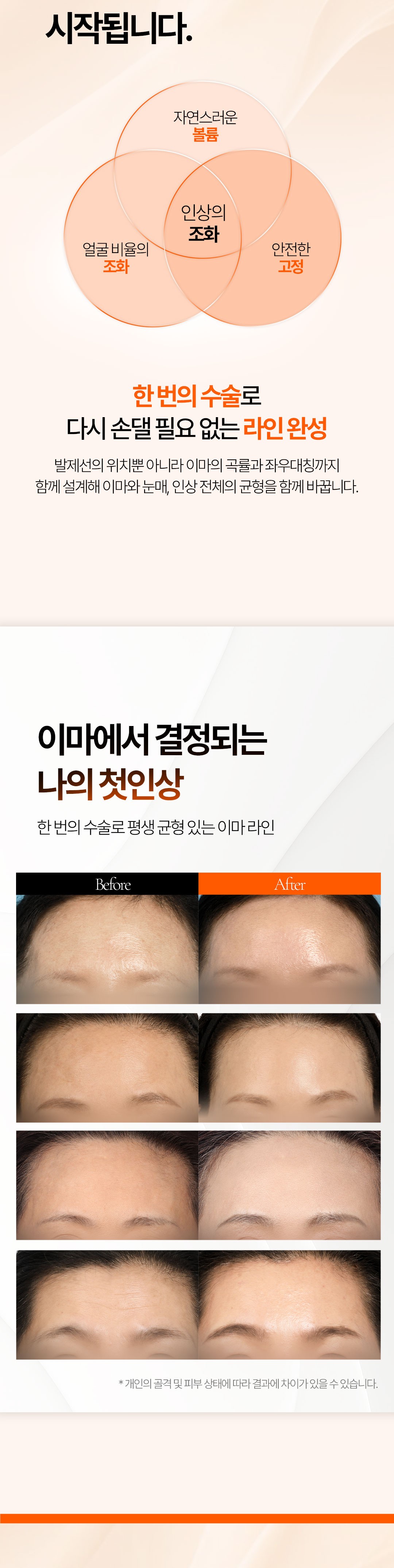 이마 리프팅 설계 원리와 시술 전후 사례