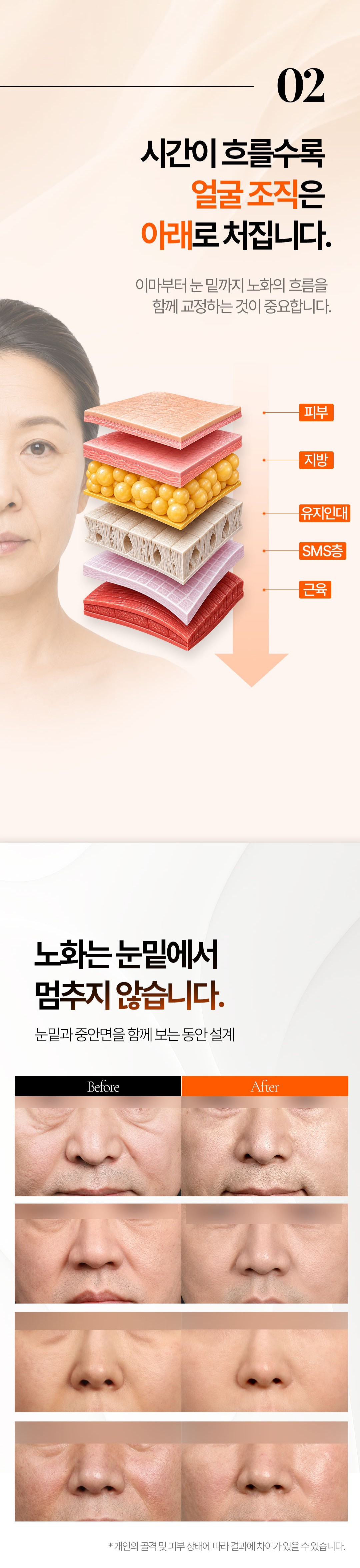 얼굴 조직 층 구조와 중안면 리프팅 전후 사례