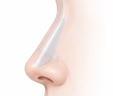 피부 아래 재료 위치를 보여주는 단순화된 그림