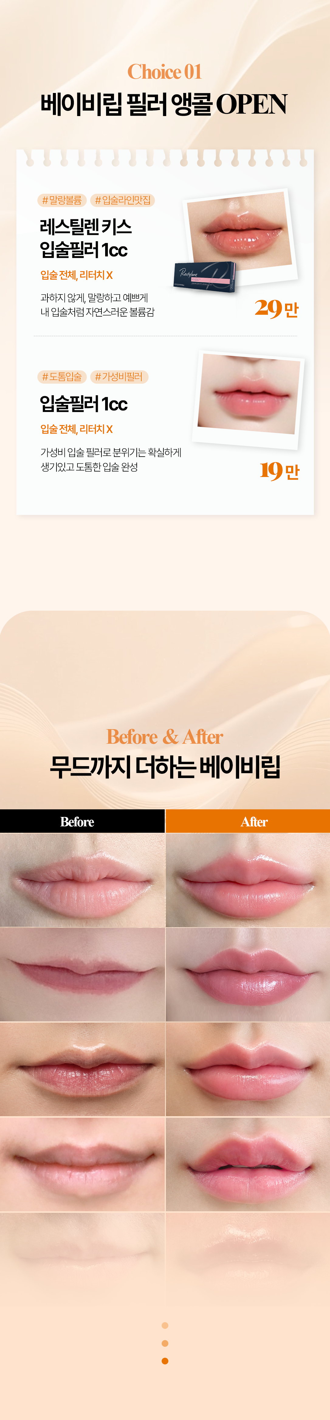 베이비립 입술 필러 구성과 시술 전후 안내
