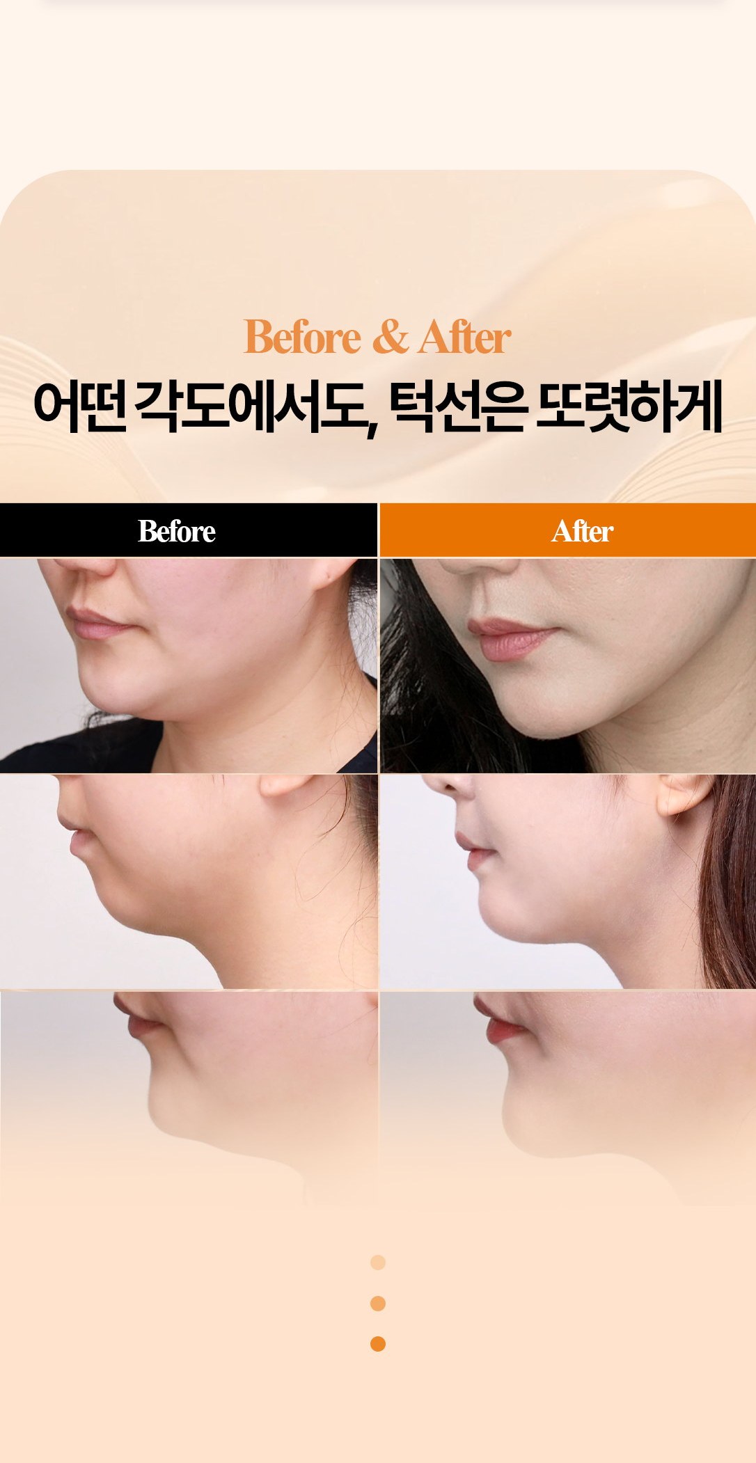 이중턱과 얼굴라인 시술 전후 예시