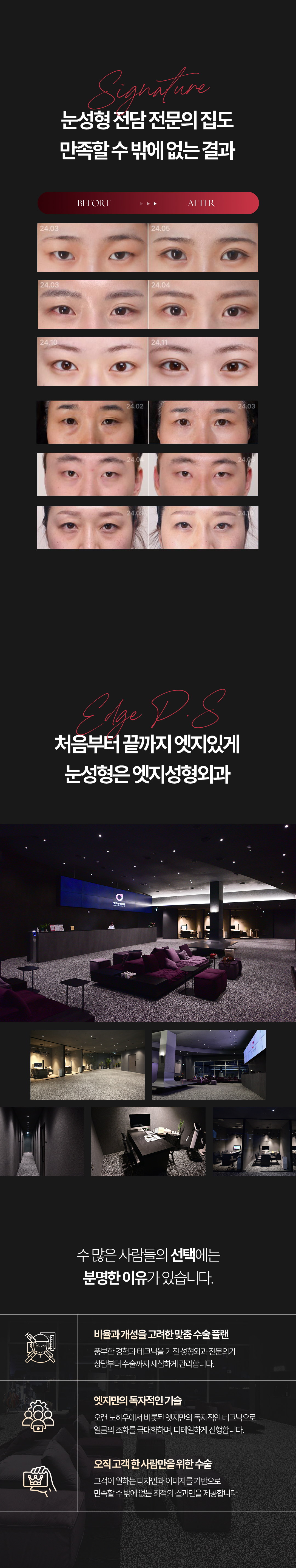 눈성형 전후 사례, 대구 엣지성형외과 진료 공간과 맞춤 수술 계획 안내