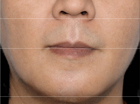 지방줄기세포SVF 윤곽재생술 후 3개월 정면 윤곽 사진 1