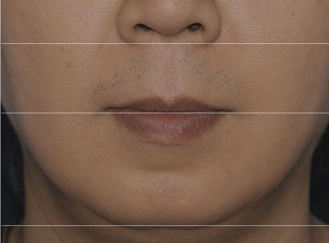 지방줄기세포SVF 윤곽재생술 전 정면 윤곽 사진 1